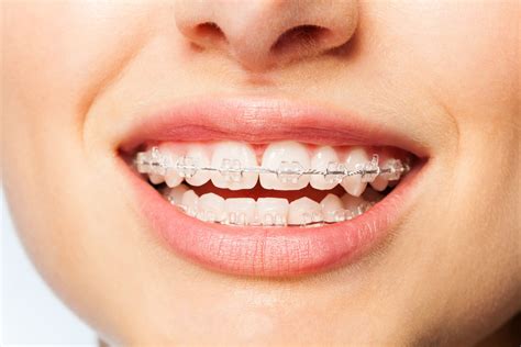 what are clear braces called